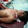 Bệnh nhân Điểu Khuê nhập viện trong tình trạng nguy kịch. (Ảnh: Bệnh viện cung cấp/TTXVN phát)