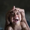 Trẻ bị dị tật đầu nhỏ do virus Zika. (Nguồn: independent.co.uk)