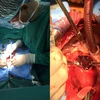 Phẫu thuật cứu sống bệnh nhân phình động mạch, biến chứng nguy kịch
