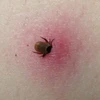 Hơn 14% dân số thế giới mắc bệnh Lyme do bọ chét cắn gây ra