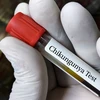 Mỹ phê duyệt vaccine đầu tiên trên thế giới ngừa virus Chikungunya