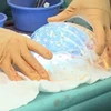 Hà Lan: Cấy ghép thành công hộp sọ 3D cho một phụ nữ