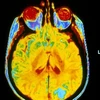 Xạ trị não bộ không giúp chữa trị căn bệnh ung thư phổi di căn