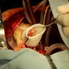 Phẫu thuật tạo hình van động mạch chủ và thay đoạn mạch nhân tạo cho bệnh nhân Hoàng A. (Ảnh: Thu Hoàng/TTXVN) 