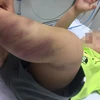 Một bé trai 1 tuổi nghi bị bạo hành, gây thương tích nghiêm trọng 