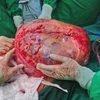 Khối u bồng trứng khổng lồ nặng 30kg sau khi đưa ra khỏi ổ bụng bệnh nhân 78 tuổi. (Ảnh: TTXVN)