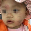 Hải Phòng: Cháu bé 14 tháng tuổi bị bầm tím mặt sau ngày đầu đi học