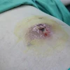 Bệnh nhân bị hoại tử vùng bụng do phòng khám tư nhân điều trị u xơ tử xung phản khoa học. (Ảnh: TTXVN phát)