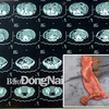 Phim chụp cắt lớp vi tính ổ bụng của bệnh nhân và đoạn ruột chứa polyp được các bác sỹ phẫu thuật cắt bỏ. (Nguồn: Báo Đồng Nai)