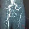 Hình ảnh chụp MSCT mạch máu của ông N. bị tắc. (Ảnh: TTXVN phát)