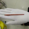 Gắp thành công chiếc đũa dài 12cm trong dương vật một bệnh nhân