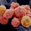 Tế bào ung thư cổ tử cung. (Nguồn: Getty Images)