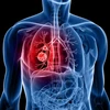 Ung thư phổi là một trong 10 căn bệnh ung thư phổ biến nhất thế giới. (Nguồn: cityofhope.org)