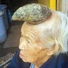 Cụ bà Liang Xiuzhen, 87 tuổi, ở Tứ Xuyên, Trung Quốc mọc sừng trên đầu. (Nguồn: Dailymail)