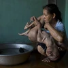 Trần Thiện Nhân, một nạn nhân của chất độc màu da cam ở Đà Nẵng, Việt Nam.