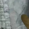 Bác sỹ chụp x-quang để xác định vị trí hai con lươn. (Nguồn: mirror.co.uk)
