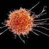 Đột phá mới trong nghiên cứu điều trị bệnh ung thư máu hiếm gặp