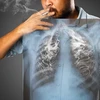Có 64% người hút thuốc được chẩn đoán mắc bệnh ung thư vẫn tiếp tục hút thuốc. (Ảnh: Vietnam+)