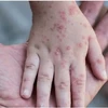 Chính phủ Hàn Quốc đã xếp bệnh đậu mùa khi vào loại bệnh truyền nhiễm cấp độ 2 trong thang 4 cấp độ. (Ảnh: Reuters/TTXVN)