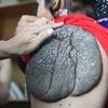 Bé gái Trần Thị Ngọc Thắm (10 tuổi, ngụ Sóc Trăng) mang khối bướu khổng lồ trên lưng. (Ảnh: Phương Vy/TTXVN)
