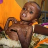 Trẻ em Somali bị suy dinh dưỡng điều trị tại bệnh viện ở Mogadishu. (Nguồn: AFP/TTXVN)