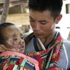 Cháu Cà Văn Hảo, 4 tuổi, ở bản Huổi Liếng (Mường La) bị đá đè vào người làm tổn thương vùng mặt và gãy chân phải. (Ảnh: Nguyễn Cường/TTXVN)