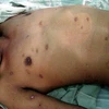 Cứu sống bệnh nhân ở Đồng Nai bị đàn ong đốt 300 mũi