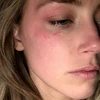 Bức ảnh nữ diễn viên Amber Heard đăng tải với những vết bầm tím trên mặt. (Nguồn: dailymail.co.uk)