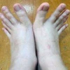 Người phụ nữ có ngón chân dài như ngón tay. (Nguồn: dailymail.co.uk)