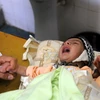  Trẻ em bị suy dinh dưỡng được điều trị tại một bệnh viện ở Sanaa, Yemen ngày 5/5. Ảnh: (Nguồn: THX/TTXVN)
