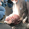 Các bác sỹ phẫu thuật bóc tách khối u buồng trứng khổng lồ. (Ảnh: TTXVN phát)