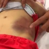 Làm rõ vụ bé trai 6 tuổi ở Tây Ninh bị mẹ ruột bạo hành đa chấn thương
