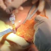 Êkíp bác sỹ Bệnh viện thẩm mỹ JW đưa khối silicon ra khỏi ngực phải bệnh nhân. (Ảnh: TTXVN phát)