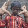 Cậu bé 8 tuổi người Ấn Độ bị xa lánh vì có đôi tay "khổng lồ"