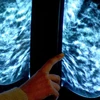 New Zealand công bố kế hoạch quốc gia về phòng chống ung thư
