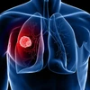 Thử nghiệm phương pháp điều trị ung thư phổi bằng tế bào gốc