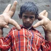 Cậu bé người Ấn Độ có bàn tay khổng lồ. (Nguồn: Daily Mail)