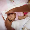 Nhiều trẻ sơ sinh bị dị tật do virus Zika. (Nguồn: AP)
