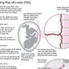 [Infographics] Những điều chưa biết về hội chứng thai nhi rượu