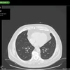 Ảnh chụp CT phổi người không mắc COVID-19. (Nguồn: Detected-X)