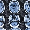 Nghiên cứu: COVID-19 có thể để lại di chứng ở não người bệnh 