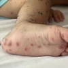 Virus Enterovirus 71 gây bệnh tay chân miệng nặng xuất hiện trở lại​
