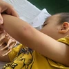 Một bệnh nhi mắc bệnh tay chân miệng đang điều trị nội trú tại Bệnh viện Nhi đồng 2 Thành phố Hồ Chí Minh. (Ảnh: Đinh Hằng/TTXVN)