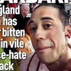 Một cổ động viên Anh bị cắn đứt tai trong trận đấu với Uruguay