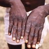 Các ban đỏ nổi trên tay một bệnh nhân mắc bệnh đậu mùa khỉ. (Nguồn: AFP/TTXVN)