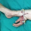 Bàn tay bị đứt lìa được ghép vào chân bệnh nhân. (Nguồn: Dailymail)