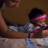 Một em bé bị mắc chứng đầu nhỏ tại thủ đô Quito, Ecuador, ngày 27/2. (Nguồn: THX/TTXVN)