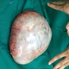 Khối u buồng trứng nặng 3,7kg được lấy ra sau khi phẫu thuật. (Ảnh: Trương Diệp/TTXVN)