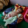  Trẻ em Yemen bị suy dinh dưỡng điều trị tại bệnh viện ở Sanaa. (Nguồn: AFP/TTXVN)