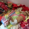 Trẻ em suy dinh dưỡng được điều trị tại bệnh viện ở Sanaa, Yemen ngày 6/10/2018. (Ảnh: AFP/TTXVN)